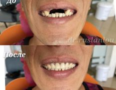 Стоматология Dental & Beauty Clinic Айнабулак (Дентал энд Бьюти Клиник Айнабулак), Примеры работ - фото 9