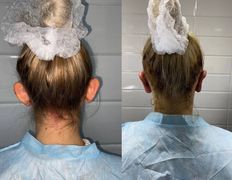 Клиника красоты и здоровья ЮТА, Отопластика - фото 19