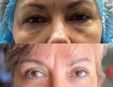 Клиника красоты и здоровья ЮТА, Блефаропластика - фото 3