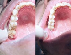 Стоматология Dental & Beauty Clinic Айнабулак (Дентал энд Бьюти Клиник Айнабулак), Примеры работ - фото 7