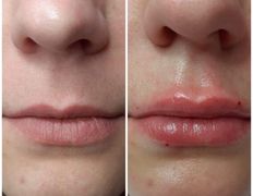 Клиника красоты и здоровья ЮТА, Увеличение губ - фото 5