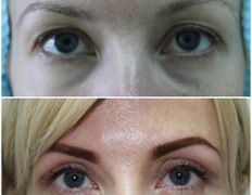Клиника красоты и здоровья ЮТА, Блефаропластика - фото 16