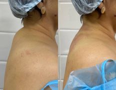 Клиника красоты и здоровья ЮТА, Липосакция холки - фото 1