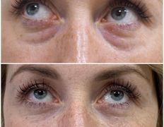 Клиника красоты и здоровья ЮТА, Блефаропластика - фото 19