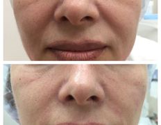 Клиника красоты и здоровья ЮТА, Коррекция носогубных морщин - фото 8