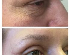 Клиника красоты и здоровья ЮТА, Блефаропластика - фото 8