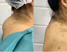 Клиника красоты и здоровья ЮТА, Липосакция холки - фото 7