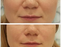 Клиника красоты и здоровья ЮТА, Коррекция носогубных морщин - фото 4