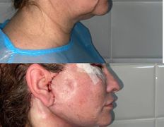 Клиника красоты и здоровья ЮТА, Подтяжка лица и шеи - фото 17