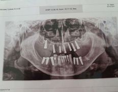 Стоматологический кабинет Айнабулак Дент, Примеры работ - фото 20