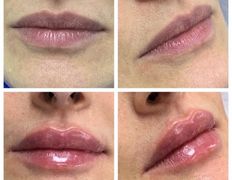 Клиника красоты и здоровья ЮТА, Увеличение губ - фото 7