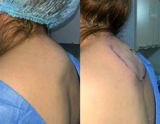 Клиника красоты и здоровья ЮТА, Липосакция холки - фото 15