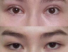 Клиника пластической хирургии и косметологии Надиалан Aesthetic (Надиалан Эстетик), Блефаропластика - фото 1