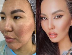 Клиника красоты и здоровья ЮТА, Блефаропластика - фото 4