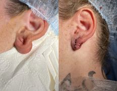 Клиника красоты и здоровья ЮТА, Отопластика - фото 8