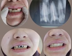 Стоматология Dental & Beauty Clinic Айнабулак (Дентал энд Бьюти Клиник Айнабулак), Примеры работ - фото 4