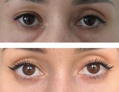 Клиника пластической хирургии и косметологии Надиалан Aesthetic (Надиалан Эстетик), Блефаропластика - фото 4