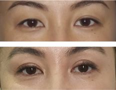 Клиника пластической хирургии и косметологии Надиалан Aesthetic (Надиалан Эстетик), Блефаропластика - фото 3