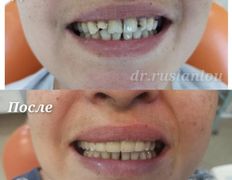 Стоматология Dental & Beauty Clinic Айнабулак (Дентал энд Бьюти Клиник Айнабулак), Примеры работ - фото 8