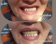 Стоматология Dental & Beauty Clinic Айнабулак (Дентал энд Бьюти Клиник Айнабулак), Примеры работ - фото 5