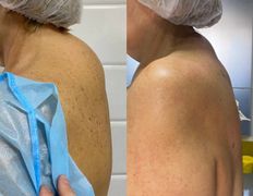 Клиника красоты и здоровья ЮТА, Липосакция холки - фото 8