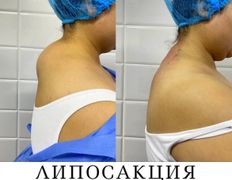Клиника красоты и здоровья ЮТА, Липосакция холки - фото 13