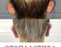 Клиника красоты и здоровья ЮТА, Отопластика - фото 12