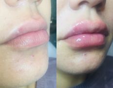 Клиника красоты и здоровья ЮТА, Увеличение губ - фото 3