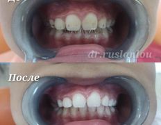 Стоматология Dental & Beauty Clinic Айнабулак (Дентал энд Бьюти Клиник Айнабулак), Примеры работ - фото 1