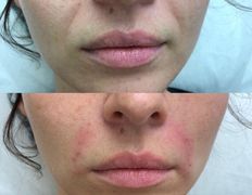 Клиника красоты и здоровья ЮТА, Коррекция носогубных морщин - фото 1