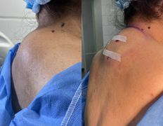 Клиника красоты и здоровья ЮТА, Липосакция холки - фото 19