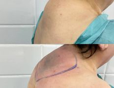Клиника красоты и здоровья ЮТА, Липосакция холки - фото 20