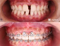 Стоматология My Dent (Май Дент), Примеры работ - фото 3