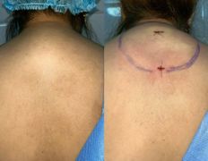 Клиника красоты и здоровья ЮТА, Липосакция холки - фото 17