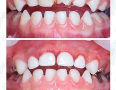 Стоматологический центр Kids Smile (Кидс Смайл), Примеры работ - фото 3