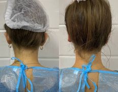 Клиника красоты и здоровья ЮТА, Отопластика - фото 18