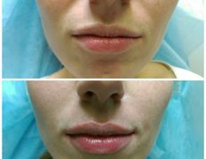 Клиника красоты и здоровья ЮТА, Коррекция носогубных морщин - фото 9
