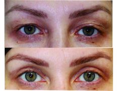 Клиника красоты и здоровья ЮТА, Блефаропластика - фото 13