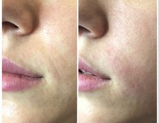 Клиника красоты и здоровья ЮТА, Коррекция носогубных морщин - фото 2
