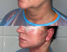 Клиника красоты и здоровья ЮТА, Подтяжка лица и шеи - фото 19