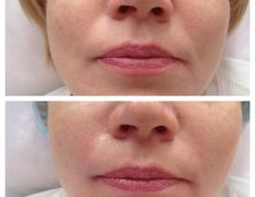 Клиника красоты и здоровья ЮТА, Коррекция носогубных морщин - фото 3