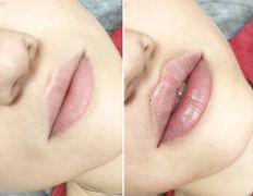 Клиника красоты и здоровья ЮТА, Увеличение губ - фото 10