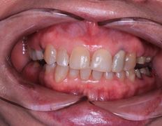 Стоматологический центр SDS dr. Bayram-Ali (Смайл Дизайн Студия), Примеры работ - фото 1