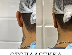 Клиника красоты и здоровья ЮТА, Отопластика - фото 17