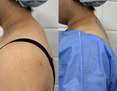 Клиника красоты и здоровья ЮТА, Липосакция холки - фото 18