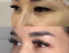 Клиника красоты и здоровья ЮТА, Блефаропластика - фото 2