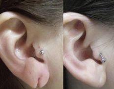 Клиника красоты и здоровья ЮТА, Отопластика - фото 6