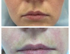 Клиника красоты и здоровья ЮТА, Коррекция носогубных морщин - фото 6