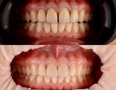 Стоматологический центр Whitestory (Уайтстори), Примеры работ - фото 2