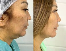 Клиника красоты и здоровья ЮТА, Подтяжка лица и шеи - фото 11